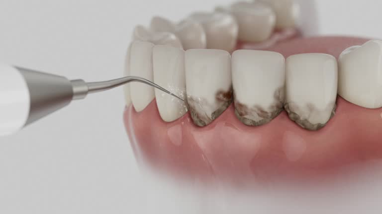 Trusted Invisalign Clear Aligners service in Des Moines, IA - Dentist Open Now